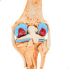 Knee Joint Arthritis Model 4 Stage Osteoarthritis