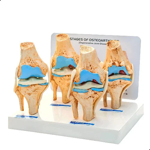 Model of stages of osteoarthritis on a white background