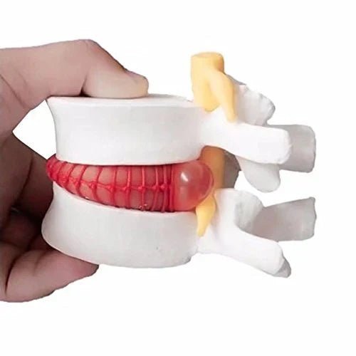 Lumbar Disc Herniation Spine - 1 Physiotherapy Equipment Manufacturers & Suppliers in India