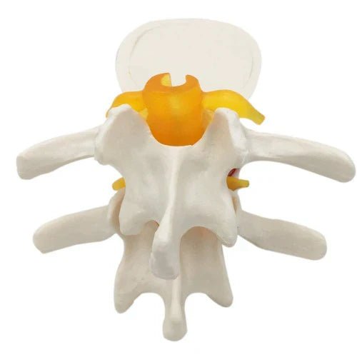 Lumbar Disc Herniation Spine - 1 Physiotherapy Equipment Manufacturers & Suppliers in India