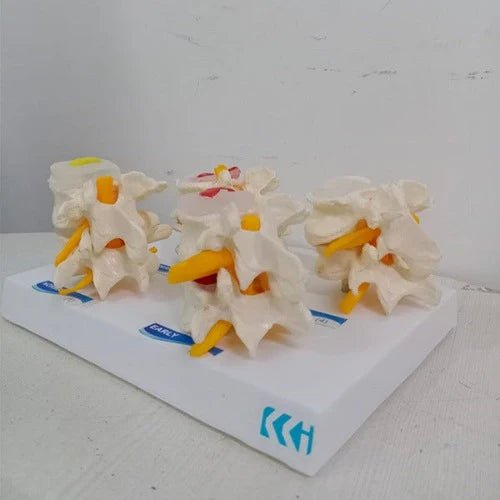 Lumbar Vertebrae Degeneration Model - 1 Physiotherapy Equipment Manufacturers & Suppliers in India