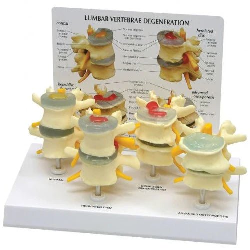 Lumbar Vertebrae Degeneration Model - 1 Physiotherapy Equipment Manufacturers & Suppliers in India