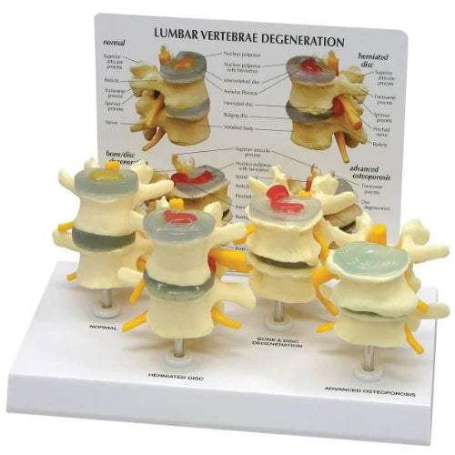 Lumbar Vertebrae Degeneration Model